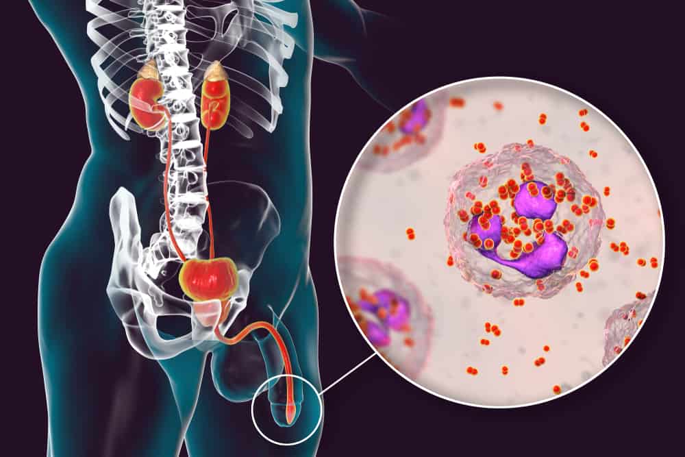 I Have Gonorrhea Symptoms: What Should I Do Next?