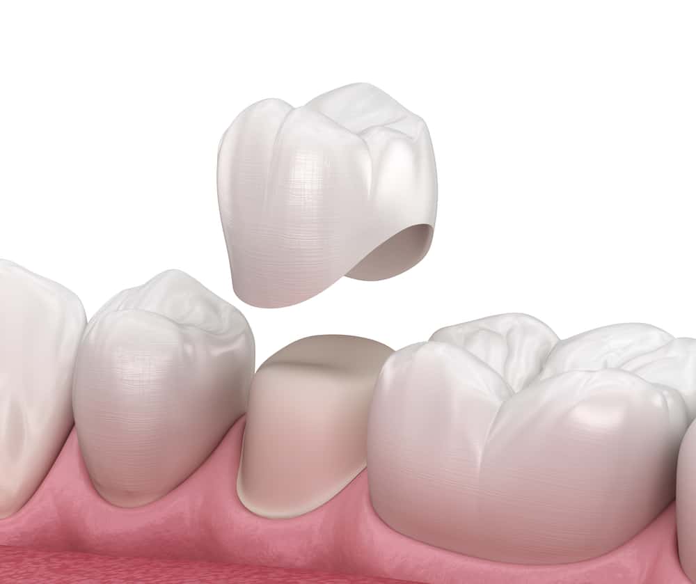 Dental Crowns: How Do They Help Your Bite and Smile?