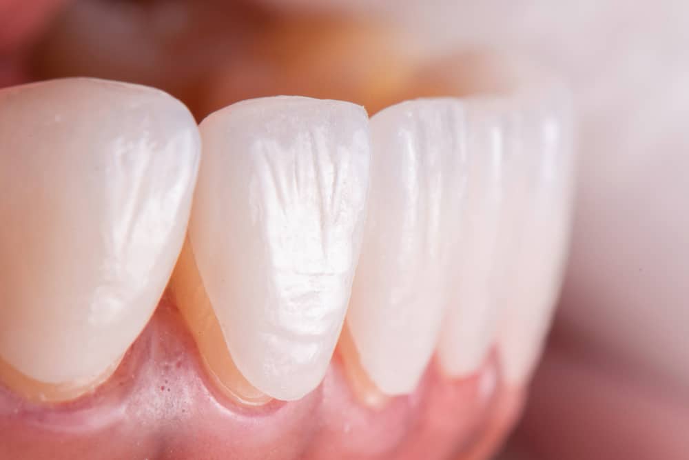 Veneer Dental: How to Achieve Those Pearly Whites Permanently