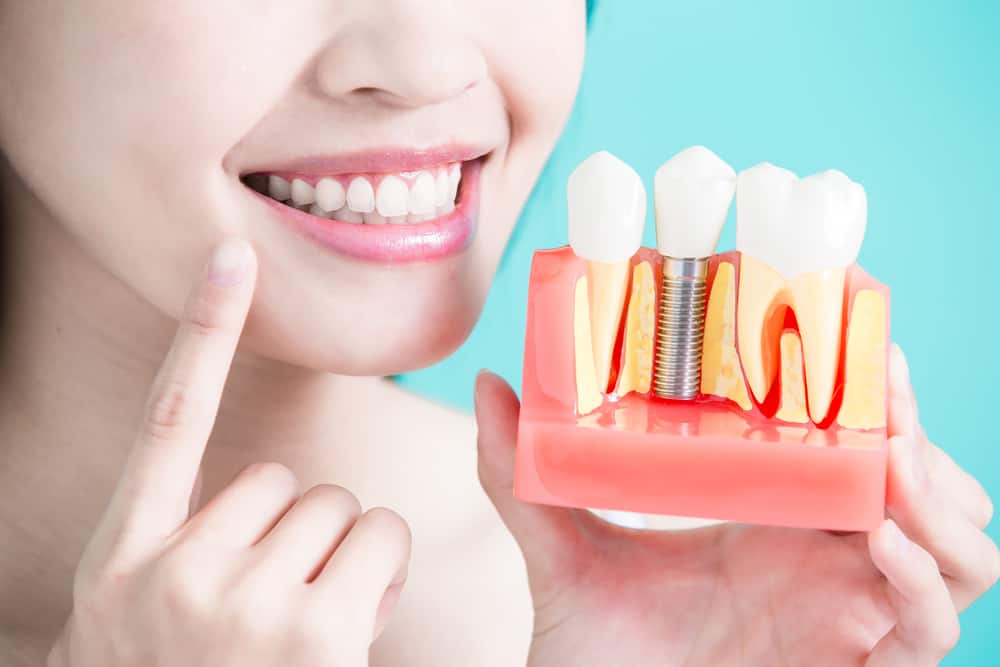 Dental Implant Cost and Other Important Concerns