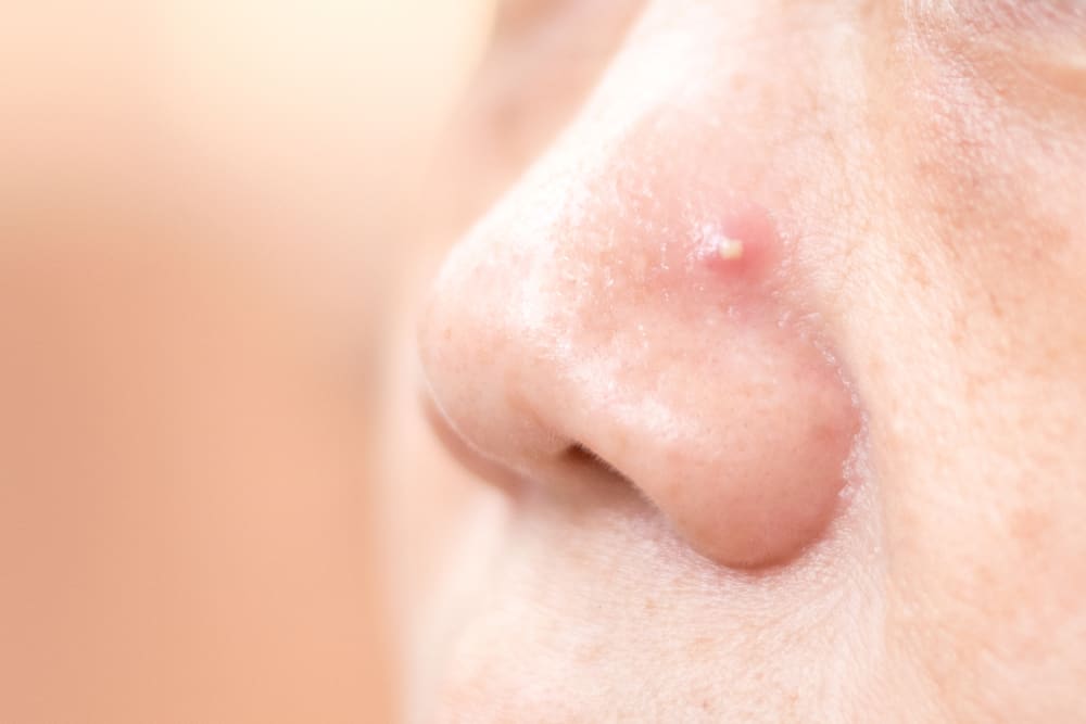 Nose Pimple: The Do's and Don'ts of Dealing with This Condition