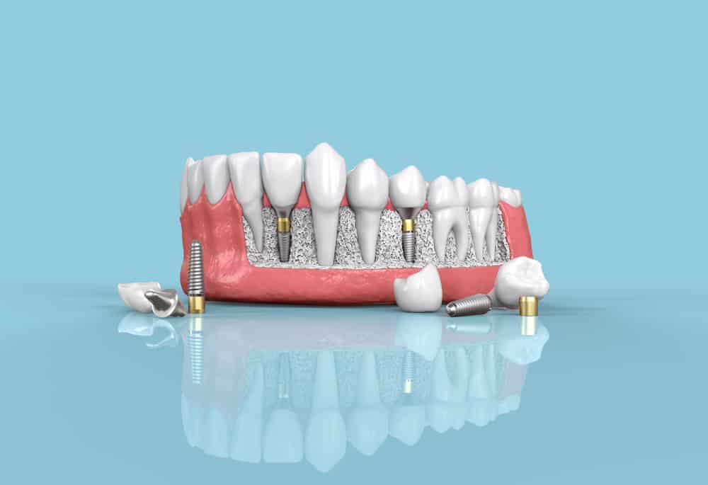 Types of Dental Implants: What You Should Consider