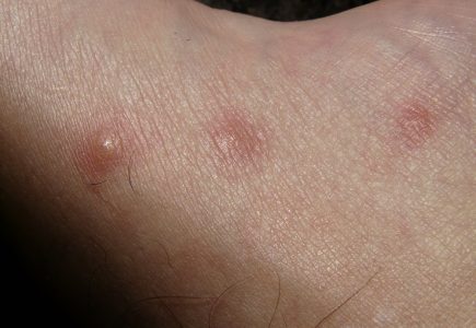 Skin Conditions Caused by Diabetes