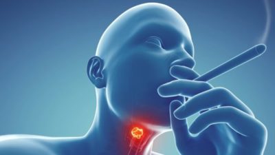 Throat Cancer: Causes, Symptoms, Treatment