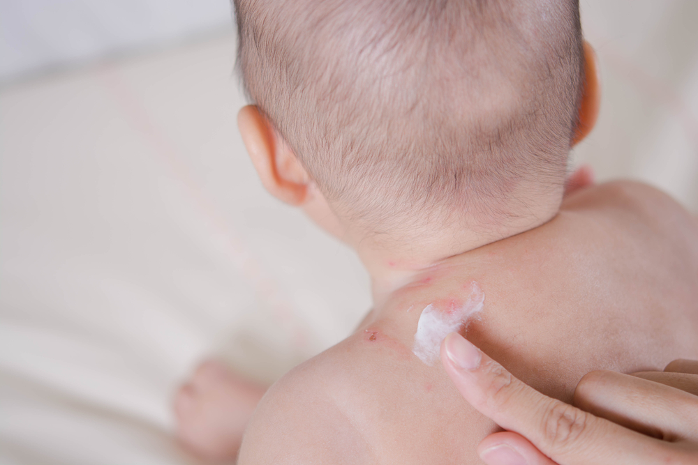 Gamot sa Pigsa ng Baby: How Do You Treat Boils in Babies?