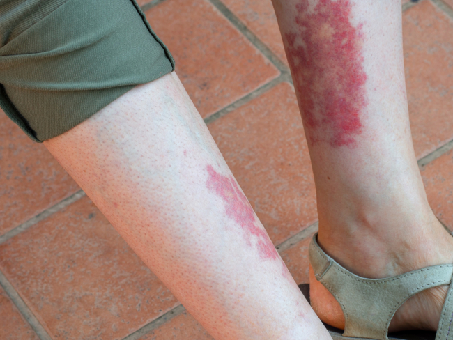 Inflamed Blood Vessels: Everything You Need to Know About Vasculitis