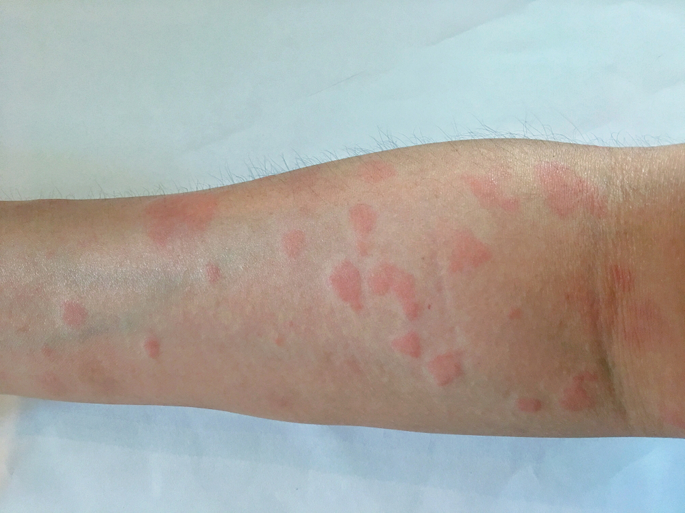 Systemic Lupus Erythematosus (SLE): What You Need to Know