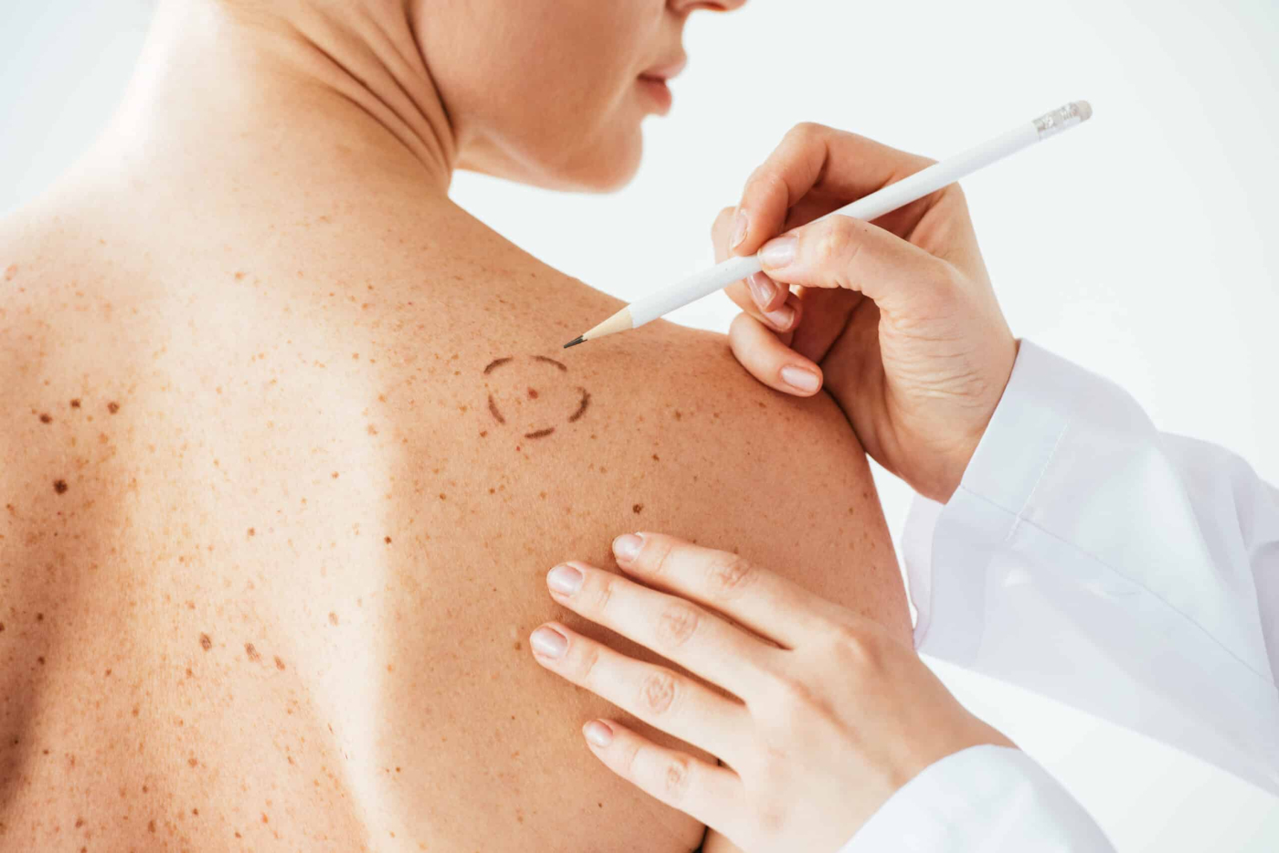 Should I Worry About This Mole? Learn About The Types of Melanoma
