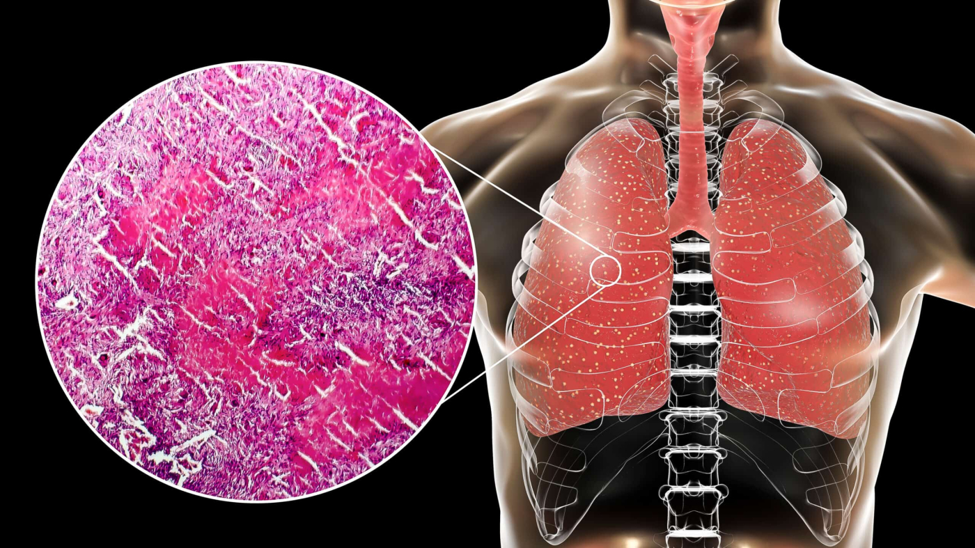 Miliary Tuberculosis: Everything You Need to Know