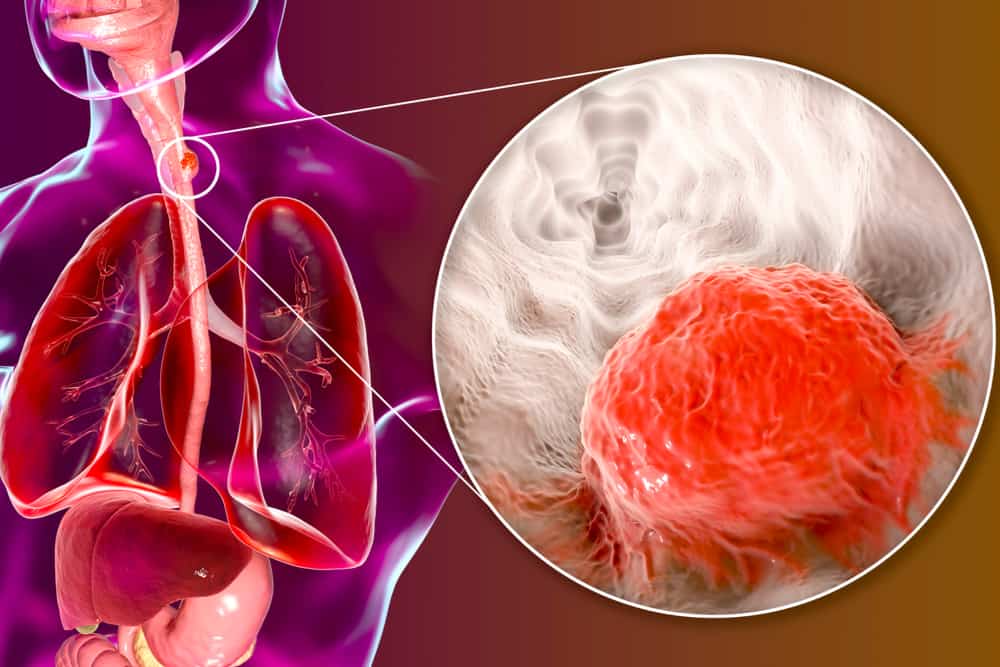 Esophageal Cancer: Learn the Signs and Symptoms