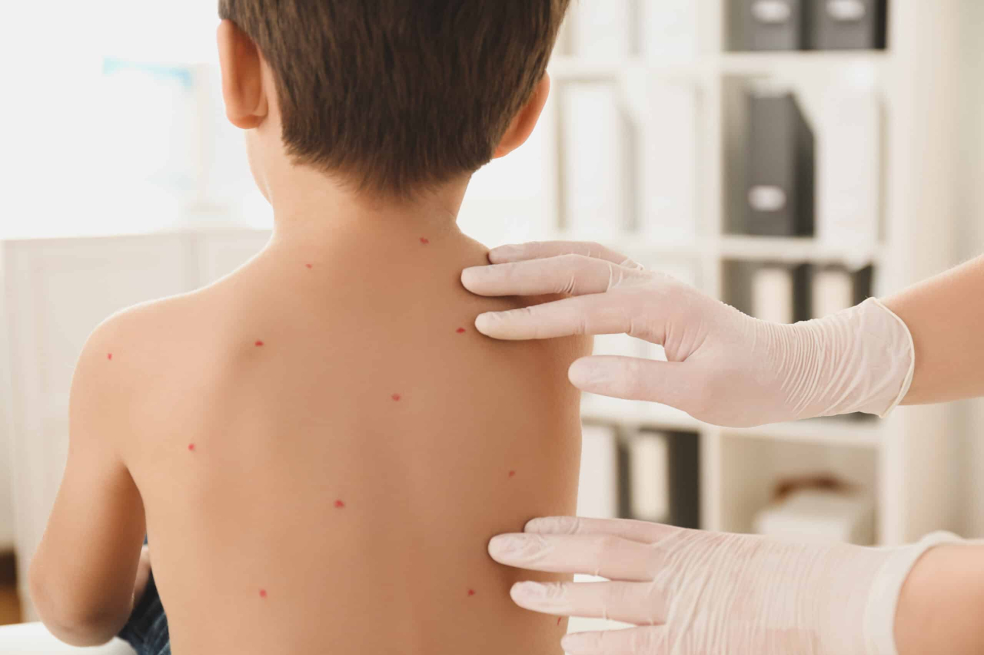 Bulutong Ba Yan? What To Do When You See Chickenpox Rash