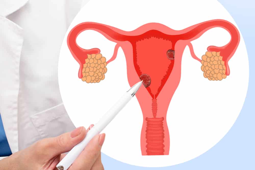 What is Endometrial Cancer? Here's What You Need to Know