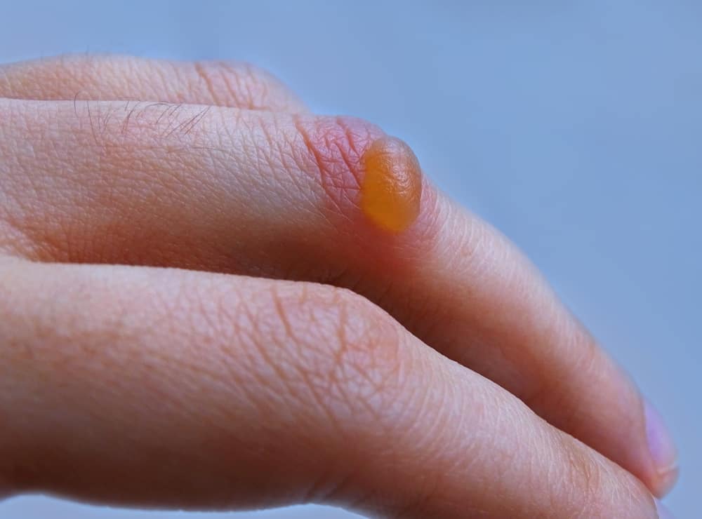 Blisters on Skin: All You Need to Know About Nature’s Band-aid
