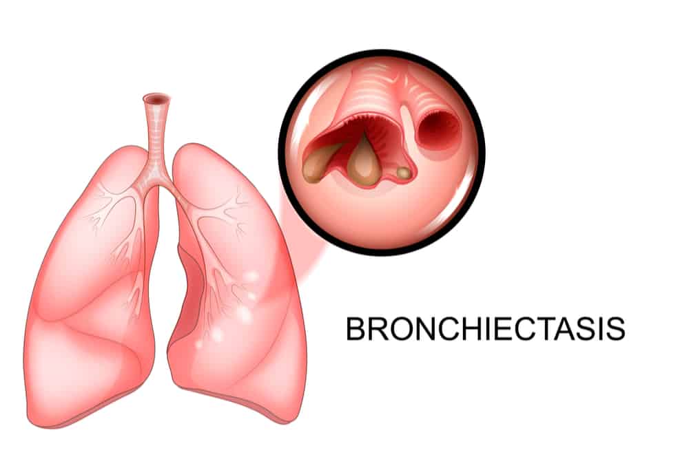 What is Bronchiectasis? Symptoms, Causes, and Treatment