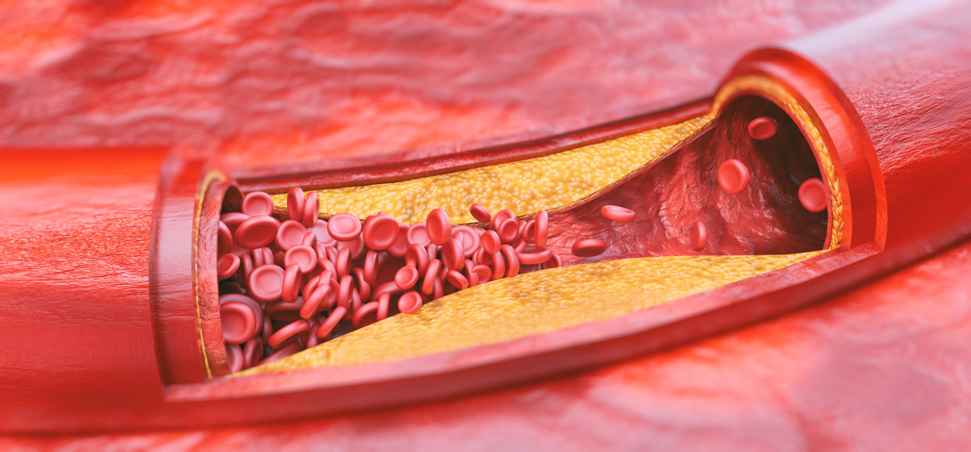 Can Atherosclerosis Spread? Here's What You Need to Know
