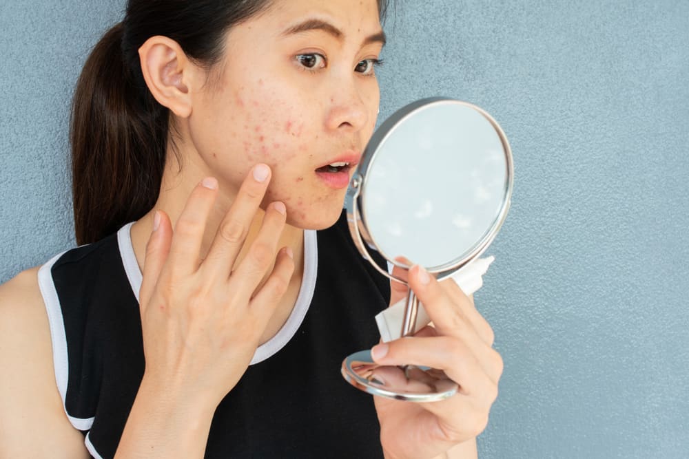 5 Foods That Heal Acne Scars