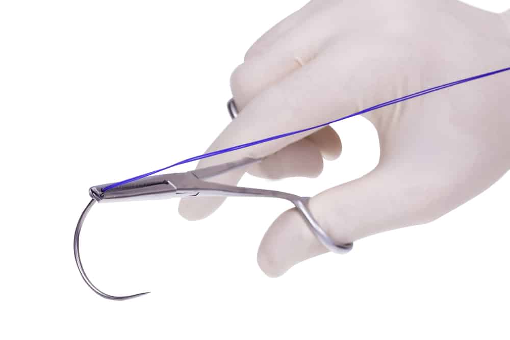 Dissolvable Stitches: How Long Will They Last?