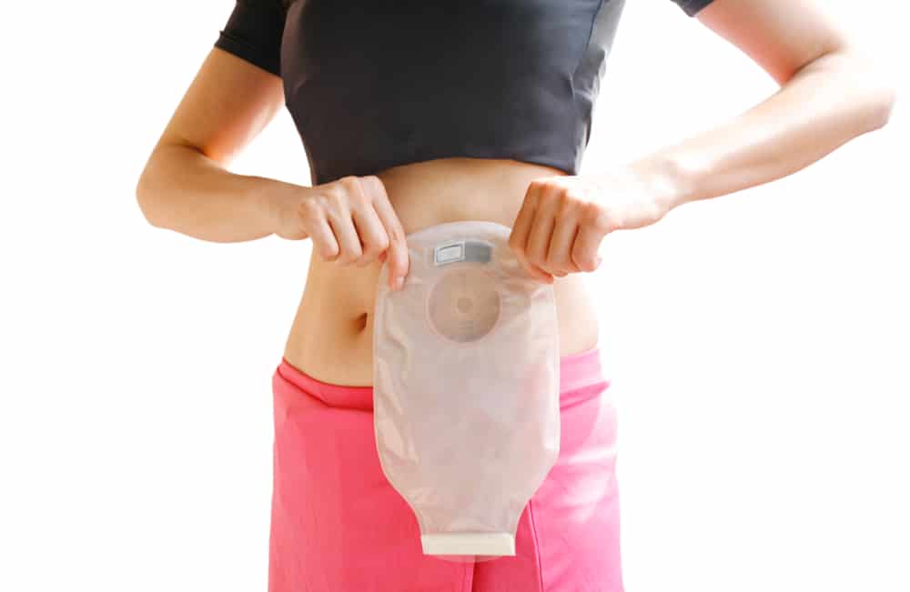 Ileostomy vs Colostomy Stoma: What's The Difference?