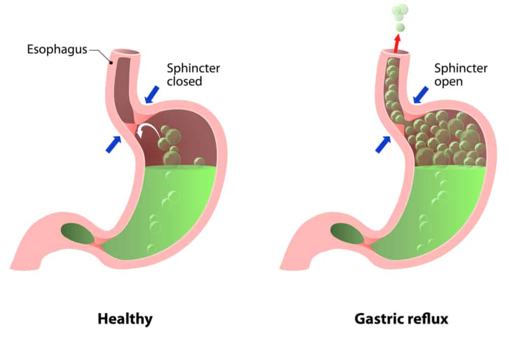 Lower Esophageal Sphincter Dysfunction: Everything You Need To Know