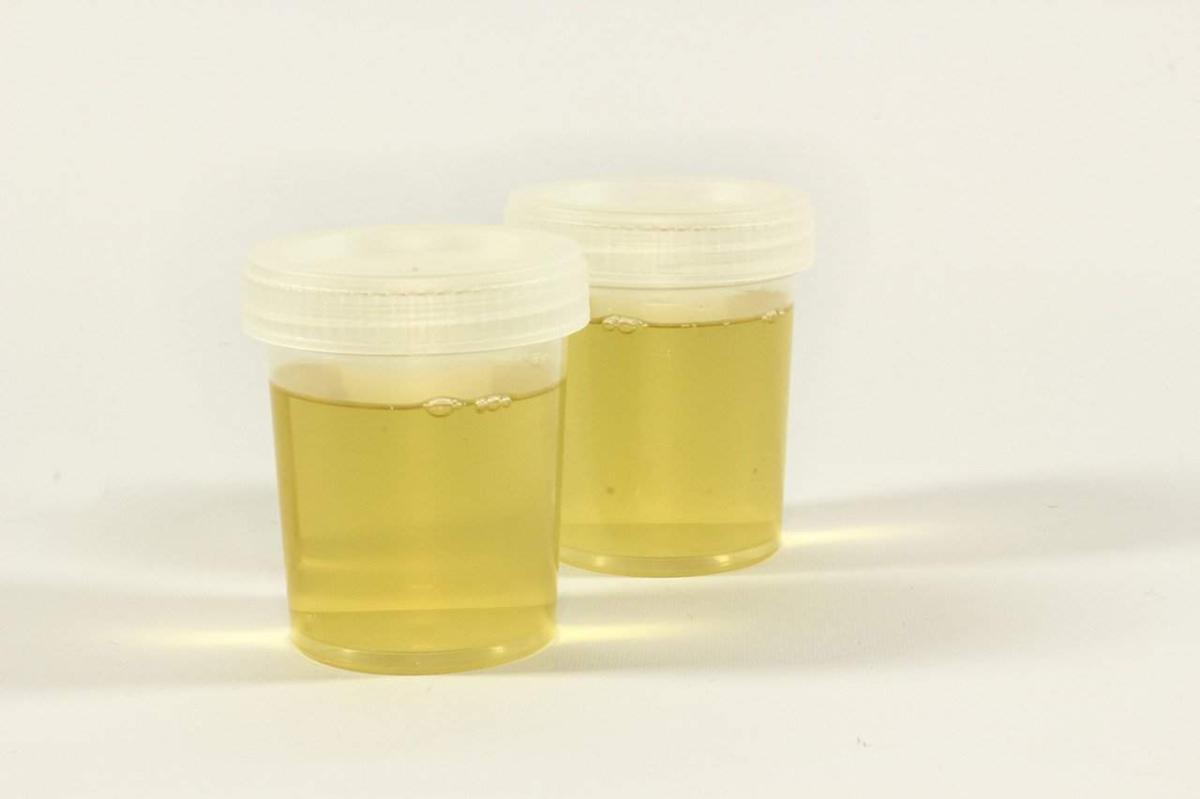 What Does Blood In Urine Indicate? When Should You Seek Help?