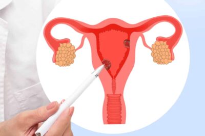 Removal of Uterine Polyps: All You Need to Know