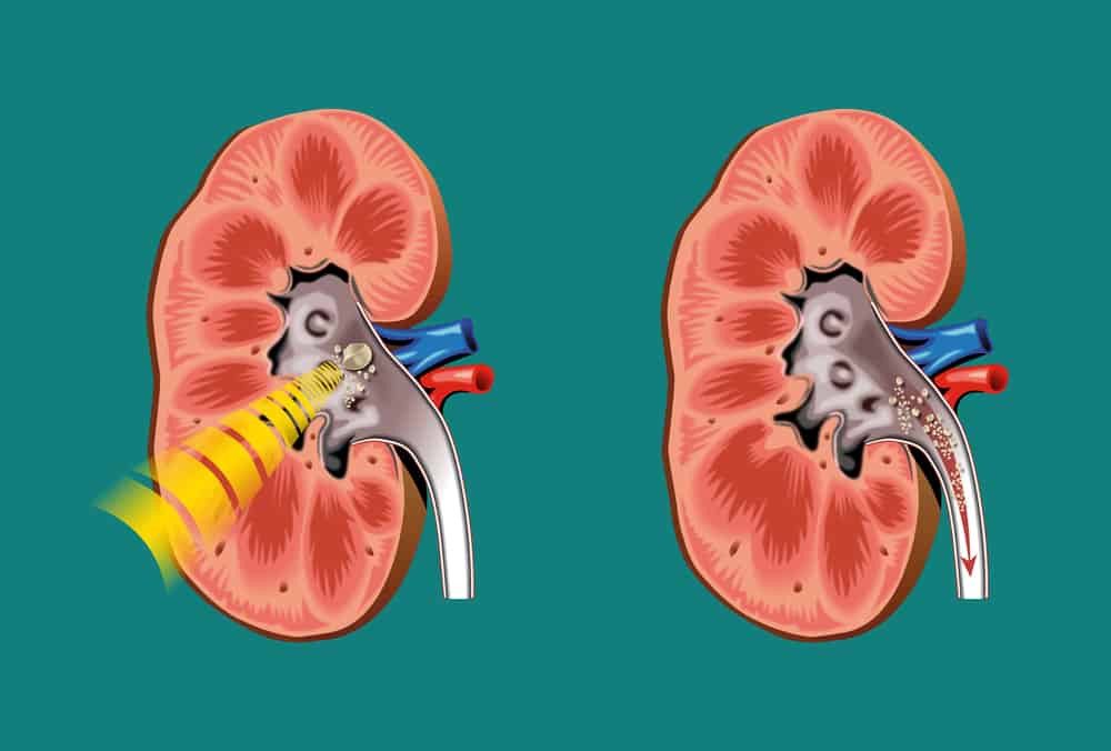 Lithotripsy for Kidney and Ureteral Stones: How is it Done?