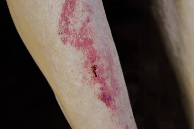 Cutaneous Vasculitis: What Are These Red and Purple Rashes?