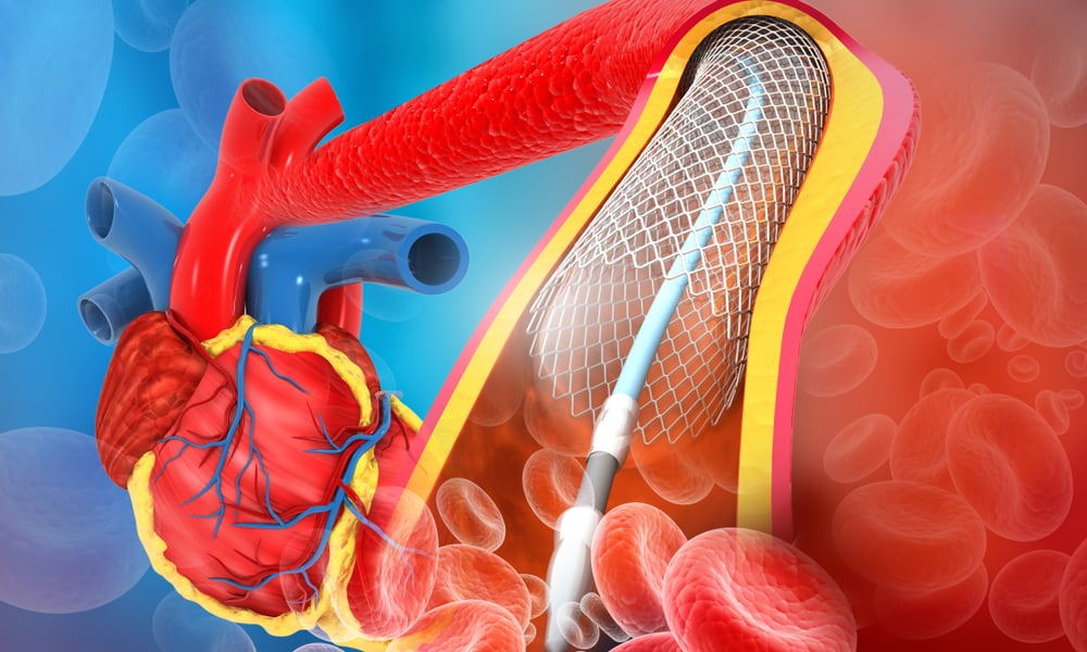 What is a Stent: Understanding Angioplasty’s Most Important Tool
