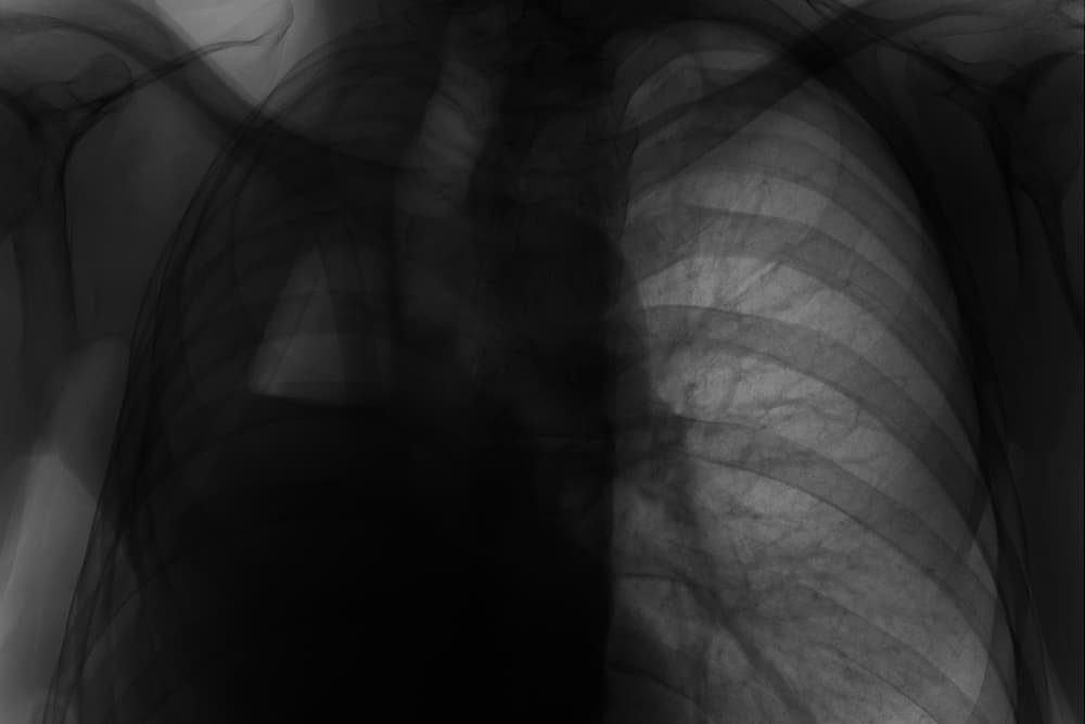 Pneumonectomy or Lung Removal: Can You Live With Only One Lung?