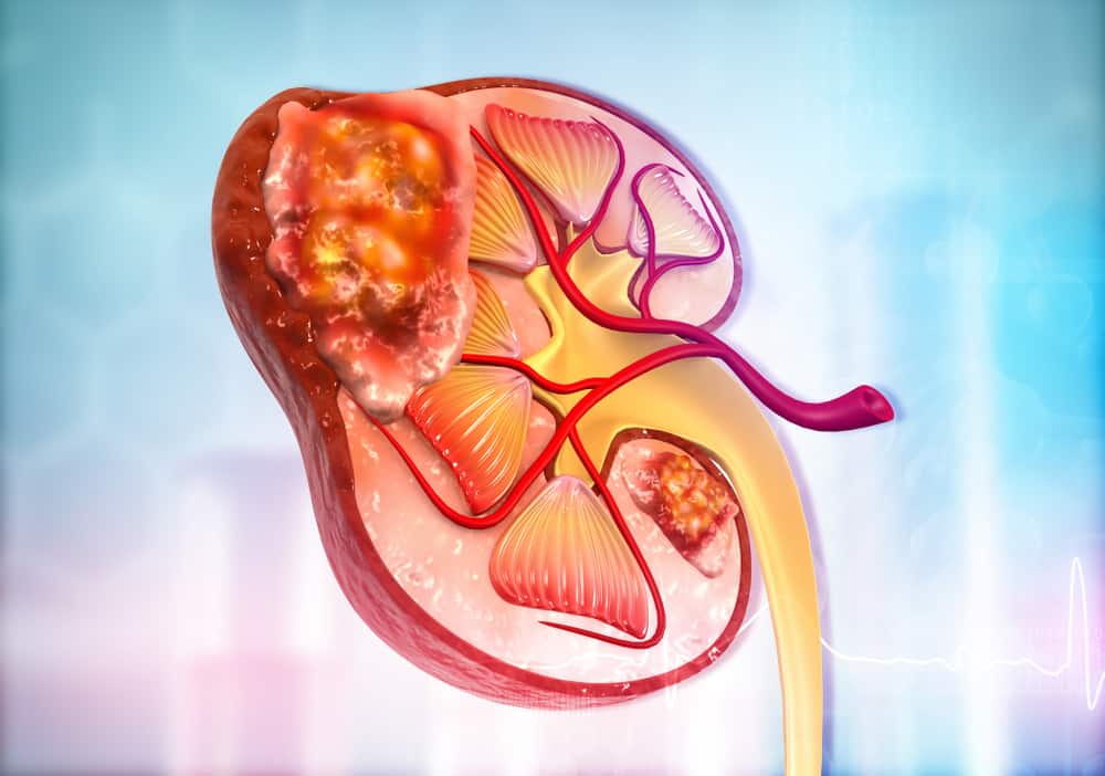 Kidney Cancer: Causes, Symptoms, Treatment