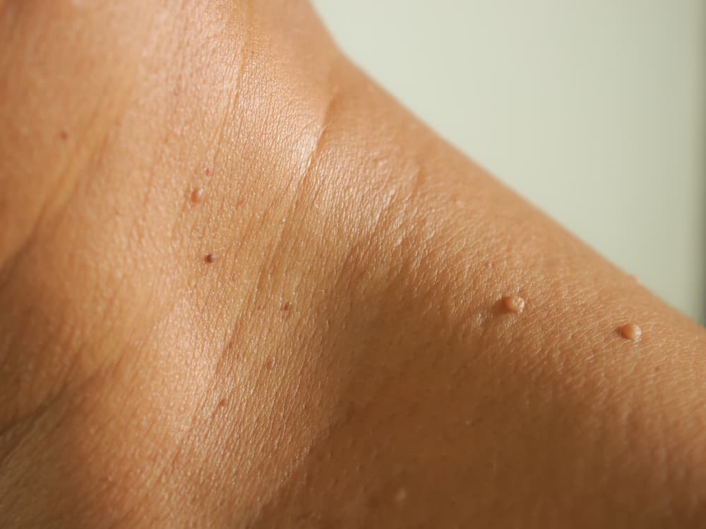 Skin Tags: Causes, Symptoms, Treatment, and Home Remedies