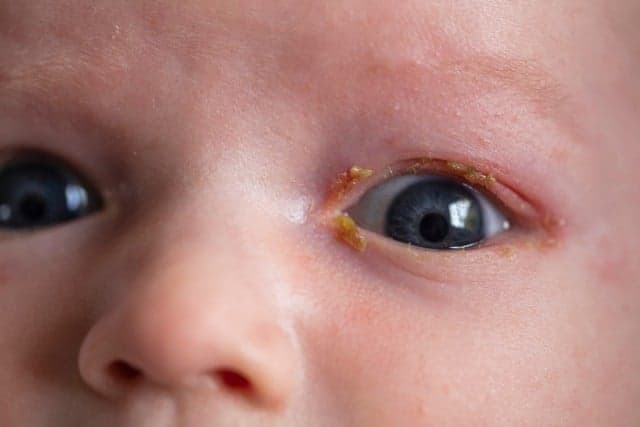 Does Your Child Have a Blocked Tear Duct?