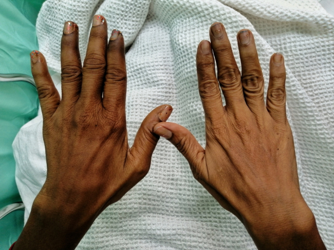 What Is Buerger's Disease? And Why Are Smokers Prone to It?