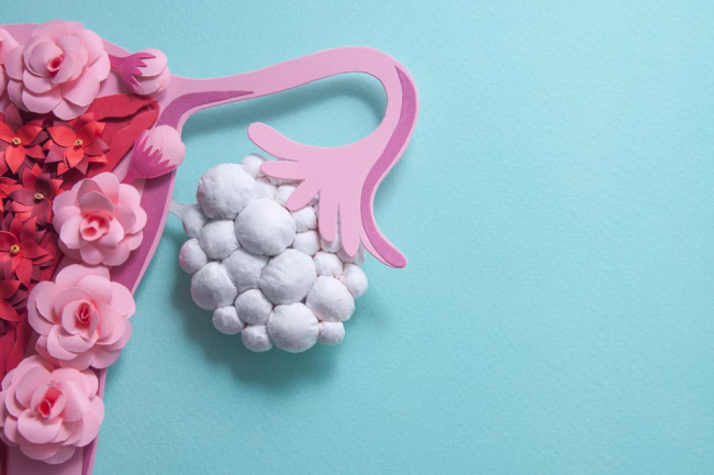 Polycystic Ovaries but Not PCOS: What is My Condition?