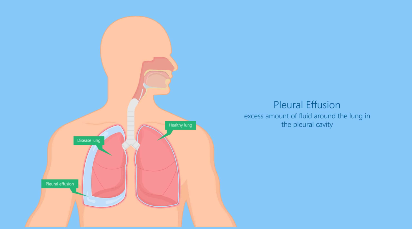 Pleural Effusion: Causes, Symptoms, Treatment