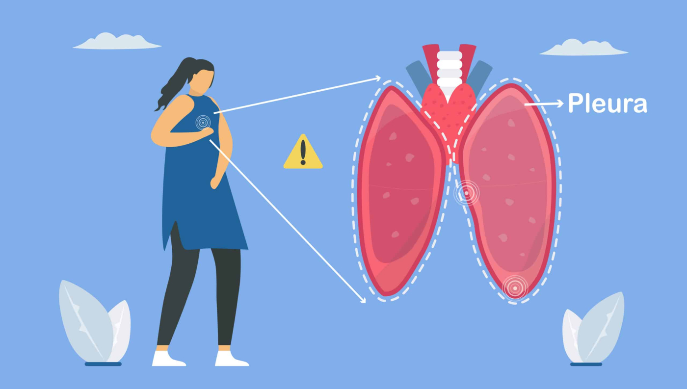 Pleurisy: Causes, Symptoms, Treatment