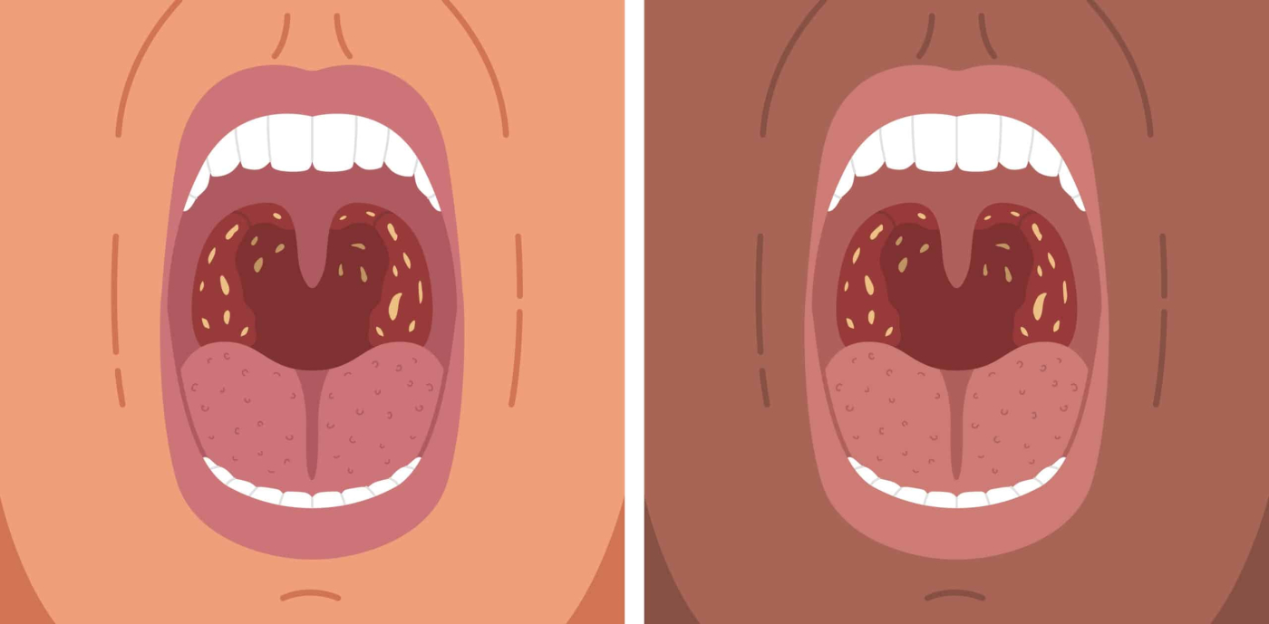 What Should You Do About Your Tonsil Stones?