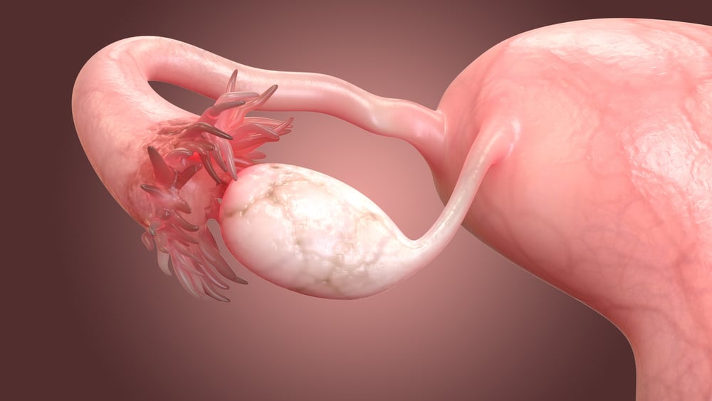 Blocked Fallopian Tubes: Causes, Symptoms, Treatment