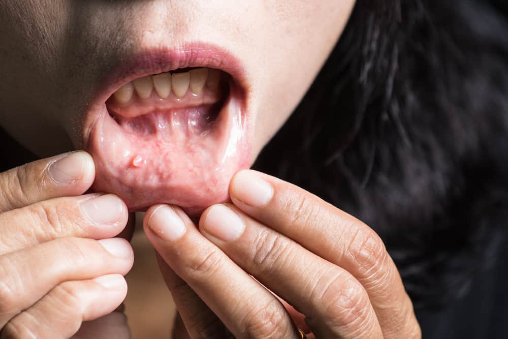 Mouth Cancer: Everything You Need to Know