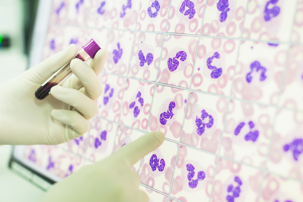 DLC Test (Differential Leukocyte Count): Why and How is it Done?