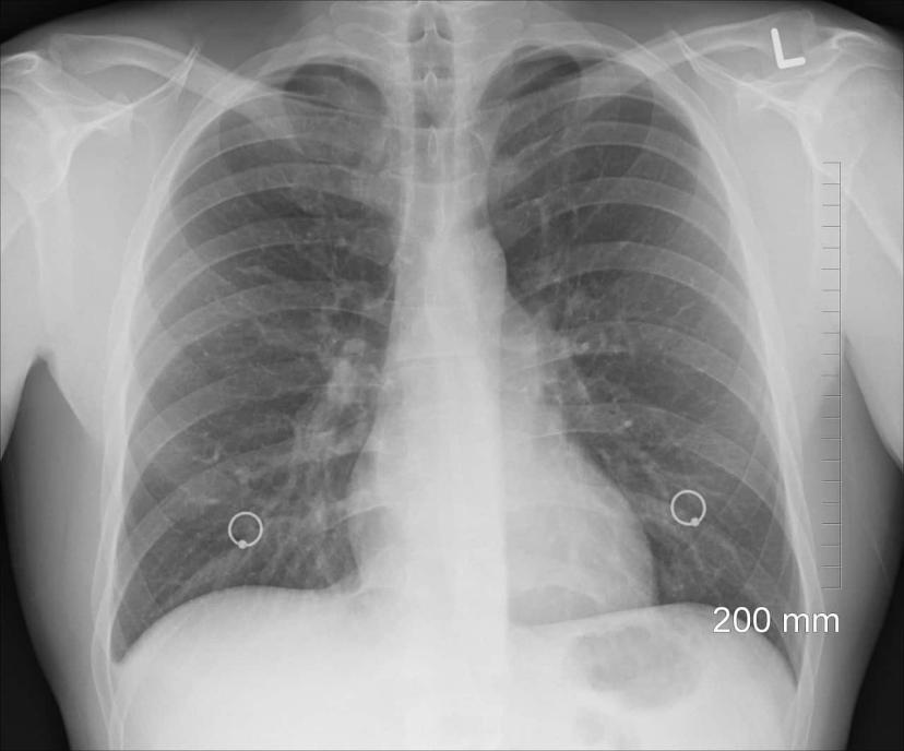 Bullous Emphysema Symptoms, Causes, and Treatment