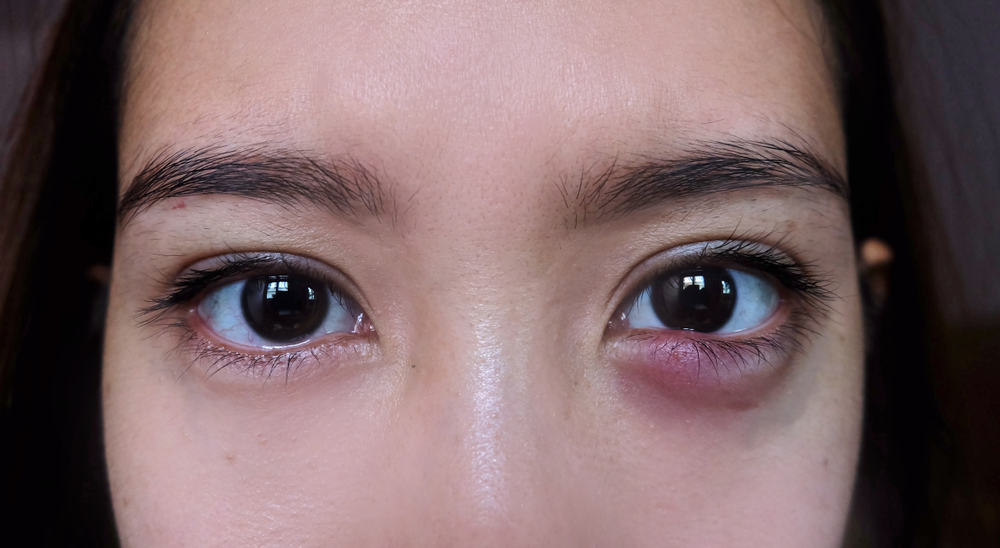 Stye (Hordeolum): Causes, Symptoms, Treatment