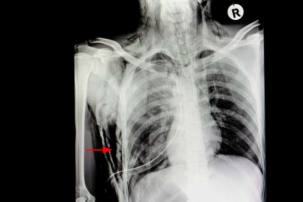 Subcutaneous Emphysema: What Makes Your Skin Bulge?
