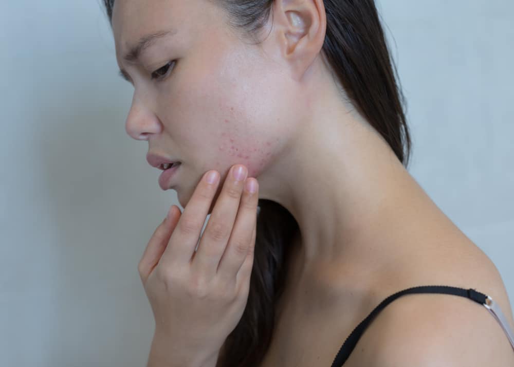 Acne Before Period: Why Does This Happen?
