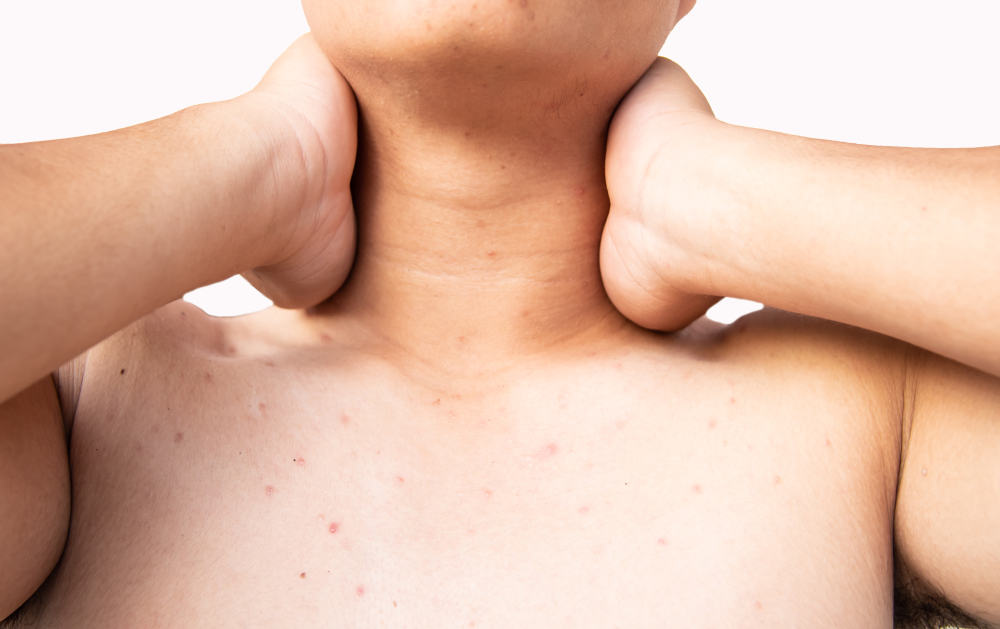 Chest Acne: Causes, Treatment & Prevention