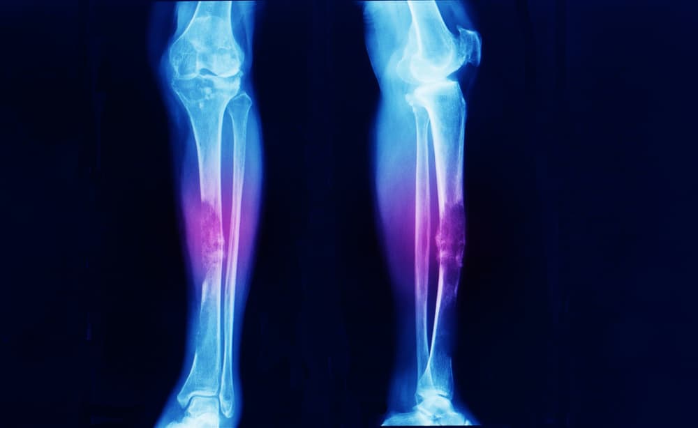 Bone Cancer: Symptoms, Causes, and Treatment of This Cancer