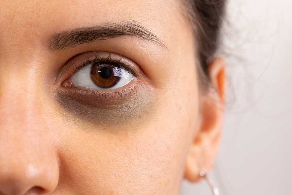 Black Eye: Causes, Treatment & Complications