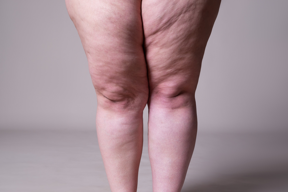 Lipoedema: Causes, Symptoms, Treatment