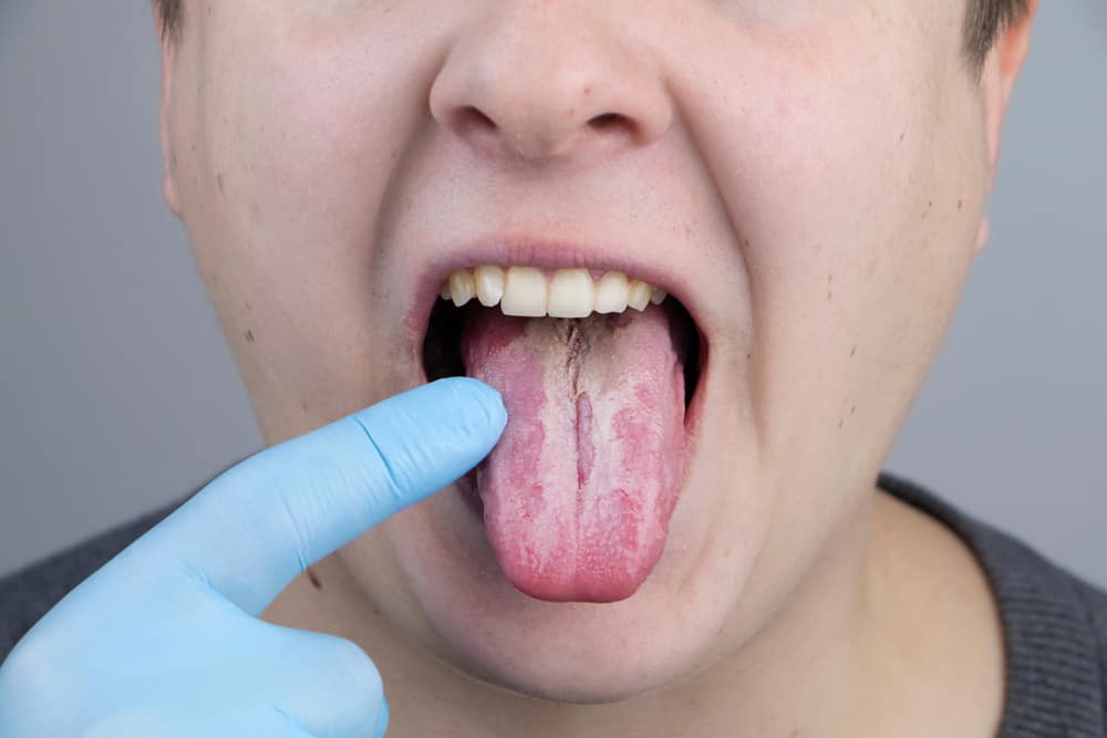 White Tongue: Causes, Symptoms, Treatment
