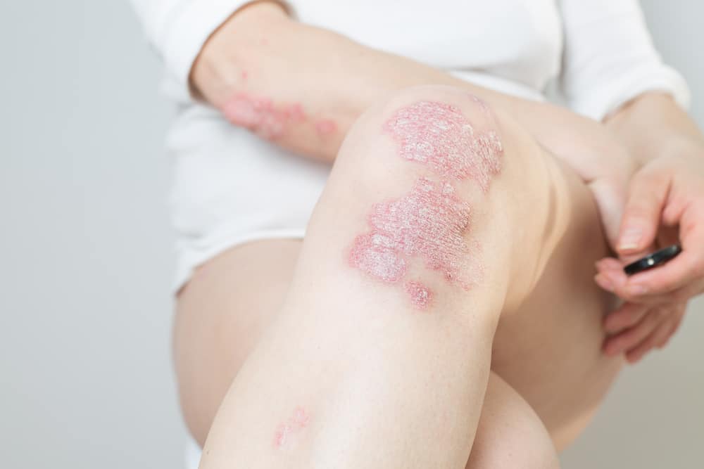 Decoding Myths about Psoriasis with Reliable Facts